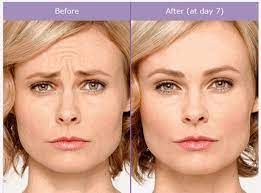 The way to obtain qualified Botox injection solutions? post thumbnail image