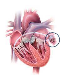 Exploring the Watchman Procedure: A Breakthrough for Atrial Fibrillation Management post thumbnail image