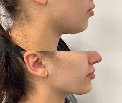 Chin Liposuction: Refining Your Facial Profile post thumbnail image