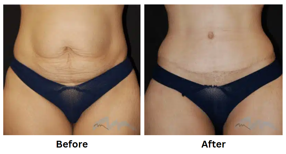 Get Ready for Summer Vacation with a Tummy Tuck in Miami post thumbnail image
