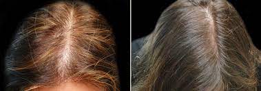 Exploring Hair Loss Treatments for Women in Tampa, Florida: Your Options Unveiled post thumbnail image