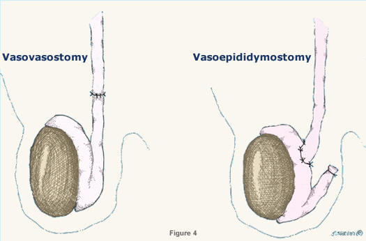 Evaluating Vasectomy Reversal Clinics: What to Look For post thumbnail image